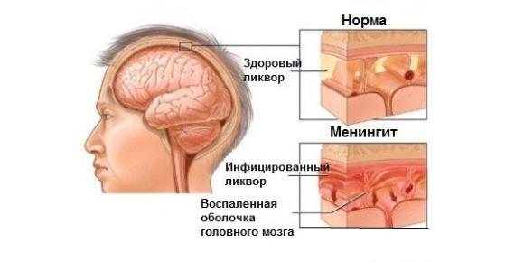 Головной мозг при менингите