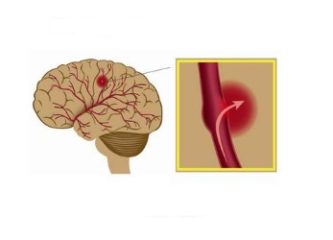 Геморрагический инсульт: причины, симптомы, лечение