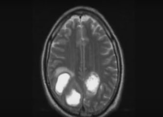 Опухоль мозга — какие симптомы должны насторожить?