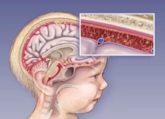 Смертельно опасная инфекция — менингит